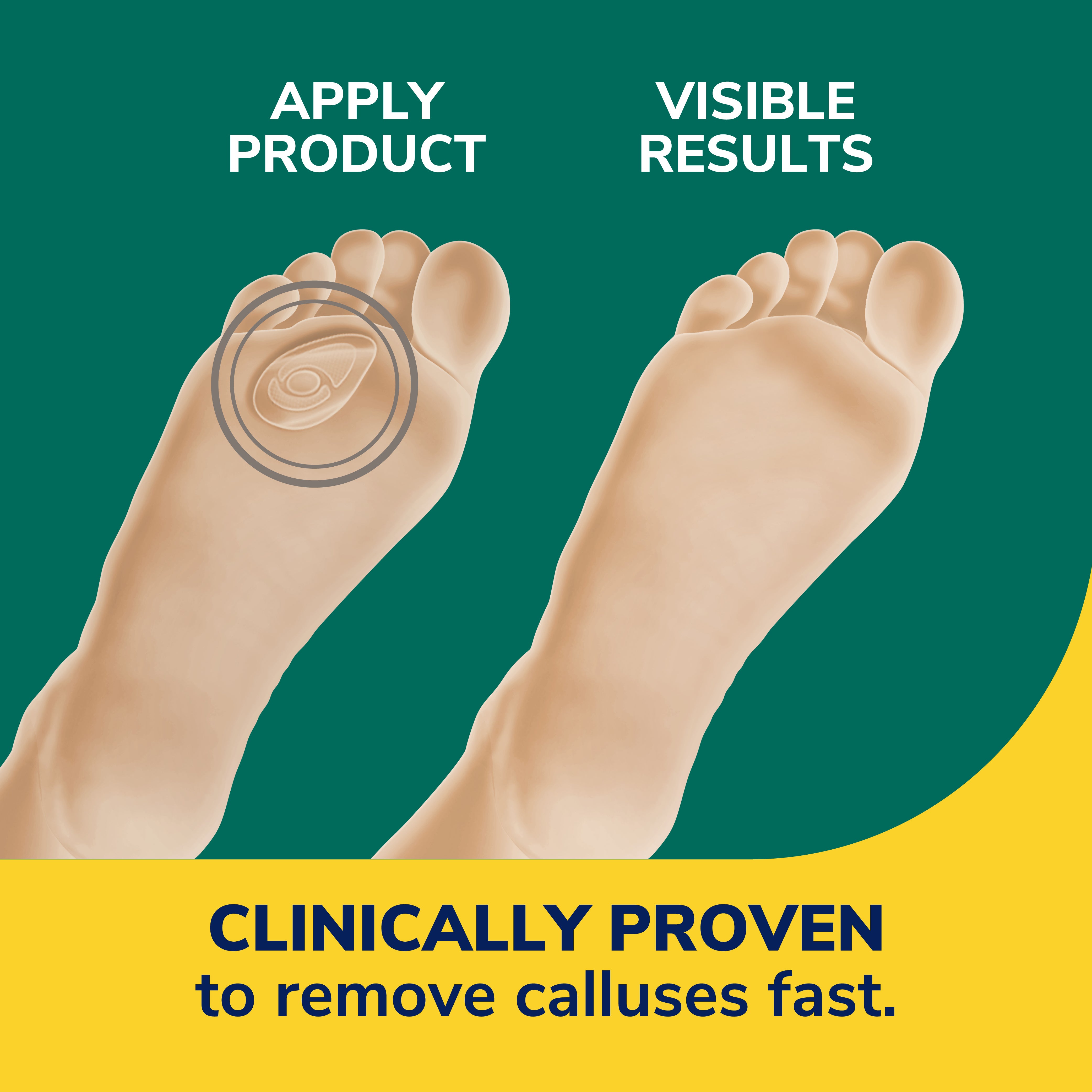 Callus Removers Seal & Heal Bandage with Hydrogel Technology